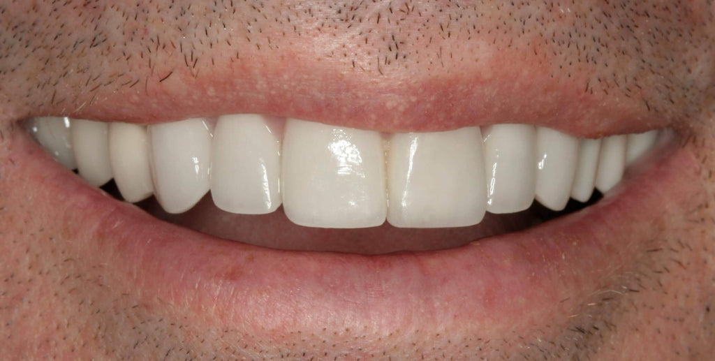 Customizable Dentures Kit with 12 Pieces D77677